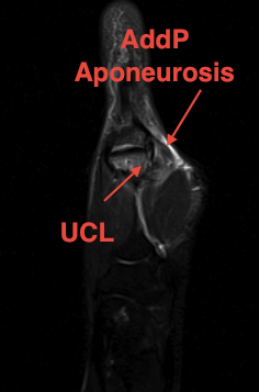 MRI UCL Proximal Undisplaced Injury